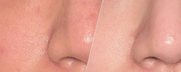before-and-after comparison of skin treatment