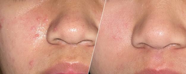 before-and-after comparison of acne skin treatment