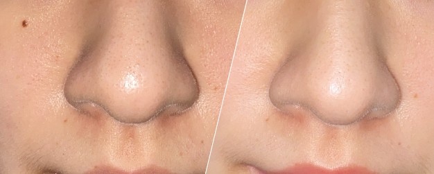 Before and after image of blackheads