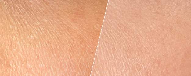 before-and-after comparison of dry skin treatment