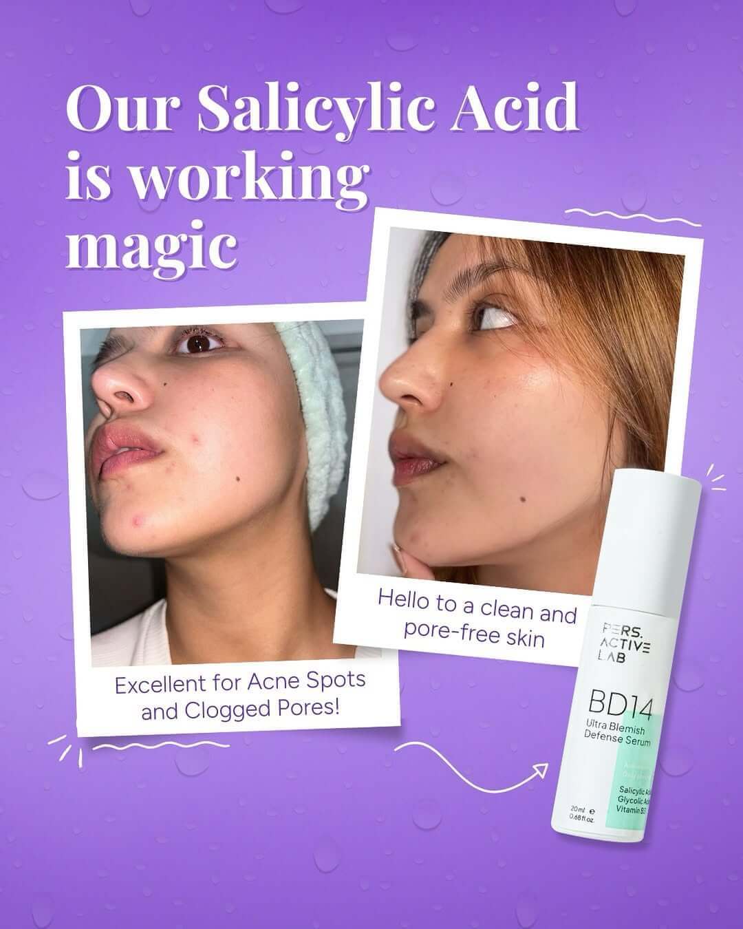 Our Salicylic Acid is working magic